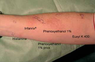 Alergia en la piel por fenoxietanol